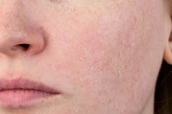 Dùng sai liều lượng Retinol trên da thì tác hại thế nào?